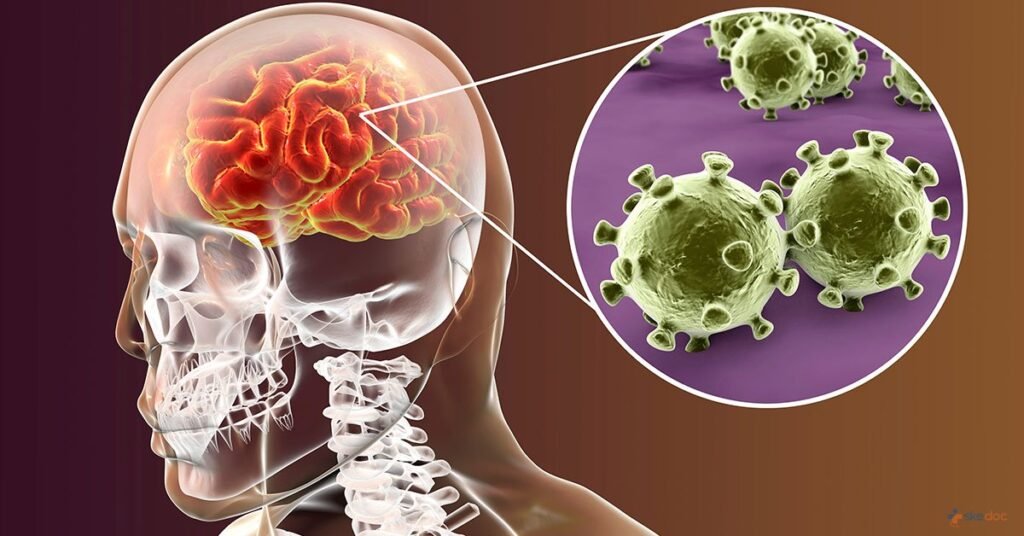 Illustration of meningitis infection in the brain